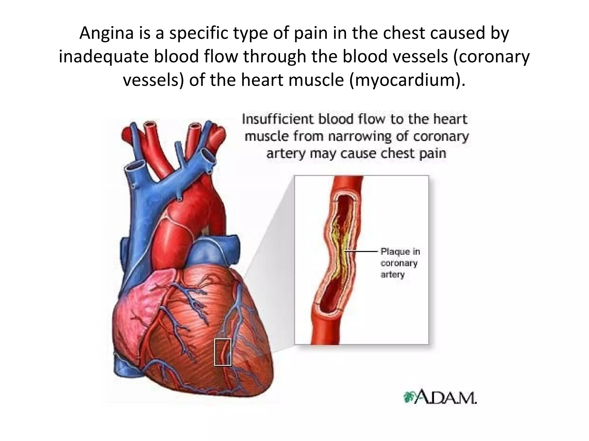 Angina is a specific type of pain in the chest caused by 
inadequate blood flow through the blood vessels (coronary 
vessels) of the heart muscle (myocardium). 
 