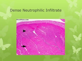 Dense Neutrophilic Infiltrate
 
