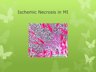 Ischemic Necrosis in MI
 