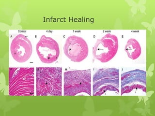 Infarct Healing
 