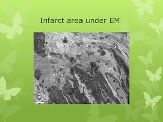Infarct area under EM
 