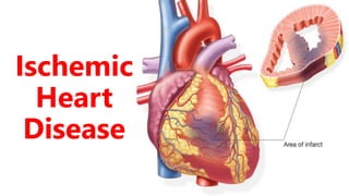 Ischemic
Heart
Disease
 