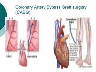 Coronary Artery Bypass Graft surgery
(CABG)
 