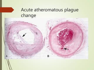 Acute atheromatous plague
change
 