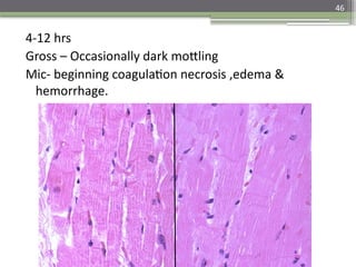 46
4-12 hrs
Gross – Occasionally dark mottling
Mic- beginning coagulation necrosis ,edema &
hemorrhage.
 