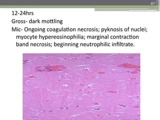 47
12-24hrs
Gross- dark mottling
Mic- Ongoing coagulation necrosis; pyknosis of nuclei;
myocyte hypereosinophilia; marginal contraction
band necrosis; beginning neutrophilic infiltrate.
 