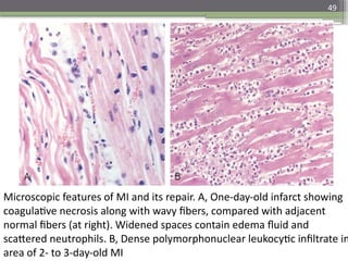 49
Microscopic features of MI and its repair. A, One-day-old infarct showing
coagulative necrosis along with wavy fibers, compared with adjacent
normal fibers (at right). Widened spaces contain edema fluid and
scattered neutrophils. B, Dense polymorphonuclear leukocytic infiltrate in
area of 2- to 3-day-old MI
 
