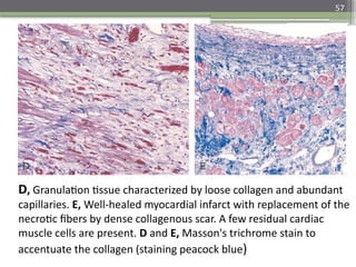 57
D, Granulation tissue characterized by loose collagen and abundant
capillaries. E, Well-healed myocardial infarct with replacement of the
necrotic fibers by dense collagenous scar. A few residual cardiac
muscle cells are present. D and E, Masson's trichrome stain to
accentuate the collagen (staining peacock blue)
 