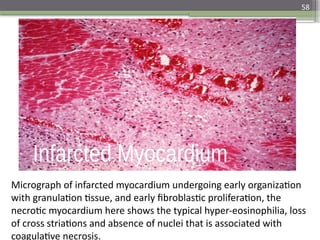 58
• Micrograph of infarcted myocardium undergoing
early organization with granulation tissue, and early
fibroblastic proliferation, the necrotic myocardium
here shows the typical hyper-eosinophilia, loss of
cross striations and absence of nuclei that is
associated with coagulative necrosis.
Micrograph of infarcted myocardium undergoing early organization
with granulation tissue, and early fibroblastic proliferation, the
necrotic myocardium here shows the typical hyper-eosinophilia, loss
of cross striations and absence of nuclei that is associated with
coagulative necrosis.
 