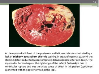 59
Acute myocardial infarct of the posterolateral left ventricle demonstrated by a
lack of triphenyl tetrazolium chloride staining in areas of necrosis (arrow); the
staining defect is due to leakage of lactate dehydrogenase after cell death. The
myocardial hemorrhage at the right edge of the infarct (asterisk) is due to
ventricular rupture and was the acute cause of death in this patient (specimen
is oriented with the posterior wall at the top).
 
