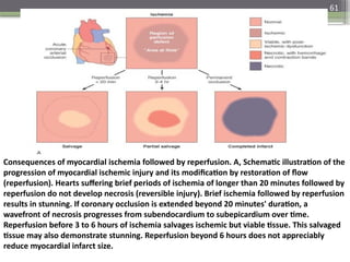61
Consequences of myocardial ischemia followed by reperfusion. A, Schematic illustration of the
progression of myocardial ischemic injury and its modification by restoration of flow
(reperfusion). Hearts suffering brief periods of ischemia of longer than 20 minutes followed by
reperfusion do not develop necrosis (reversible injury). Brief ischemia followed by reperfusion
results in stunning. If coronary occlusion is extended beyond 20 minutes' duration, a
wavefront of necrosis progresses from subendocardium to subepicardium over time.
Reperfusion before 3 to 6 hours of ischemia salvages ischemic but viable tissue. This salvaged
tissue may also demonstrate stunning. Reperfusion beyond 6 hours does not appreciably
reduce myocardial infarct size.
 
