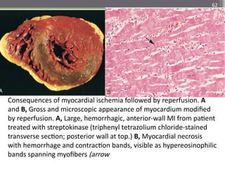 62
Consequences of myocardial ischemia followed by reperfusion. A
and B, Gross and microscopic appearance of myocardium modified
by reperfusion. A, Large, hemorrhagic, anterior-wall MI from patient
treated with streptokinase (triphenyl tetrazolium chloride-stained
transverse section; posterior wall at top.) B, Myocardial necrosis
with hemorrhage and contraction bands, visible as hypereosinophilic
bands spanning myofibers (arrow
 