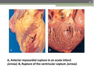 74
A, Anterior myocardial rupture in an acute infarct
(arrow). B, Rupture of the ventricular septum (arrow).
 