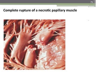 75
Complete rupture of a necrotic papillary muscle
 