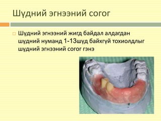 Шүдний эгнээний согог
 Шүдний эгнээний жигд байдал алдагдан
шүдний нуманд 1-13шүд байхгүй тохиолдлыг
шүдний эгнээний согог гэнэ
 