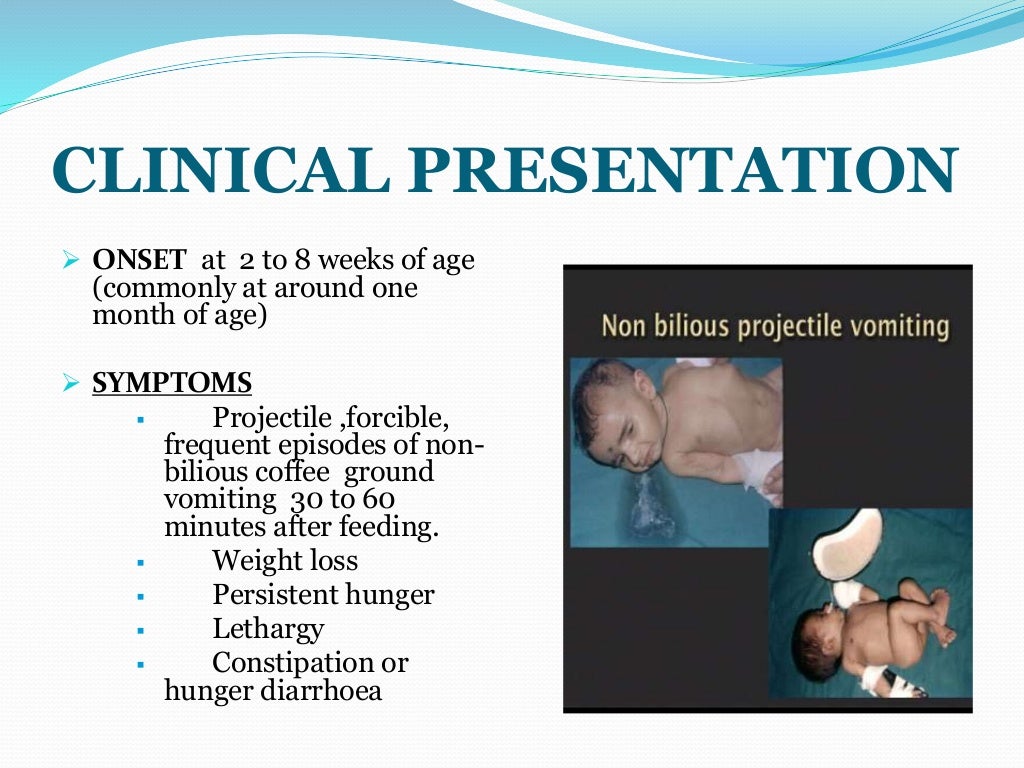 INFANTILE HYPERTROPHIC PYLORIC STENOSIS