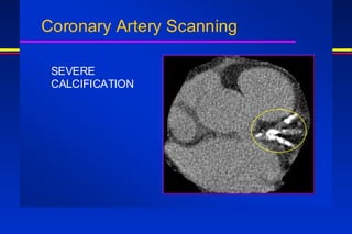 Coronary Artery Scanning
SEVERE
CALCIFICATION
 