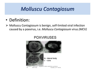 Molluscu Contagiosum
• Definition:
 Molluscu Contagiosum is benign, self-limited viral infection
caused by a poxvirus, i.e. Molluscu Contagiosum virus (MCV)
 