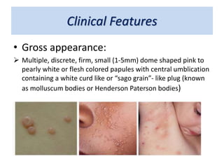 Clinical Features
• Gross appearance:
 Multiple, discrete, firm, small (1-5mm) dome shaped pink to
pearly white or flesh colored papules with central umblication
containing a white curd like or “sago grain”- like plug (known
as molluscum bodies or Henderson Paterson bodies)
 