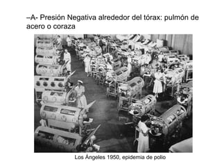 –A- Presión Negativa alrededor del tórax: pulmón de
acero o coraza
Los Ángeles 1950, epidemia de polio
 