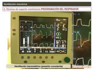 6. Técnicas de soporte ventilatorio-PROGRAMACIÓN DEL RESPIRADOR
Ventilación mecánica
Ventilación barométrica (presión constante)
 