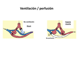 Ventilación / perfusión
No ventilación
Shunt
Espacio
muerto
No perfusión
 