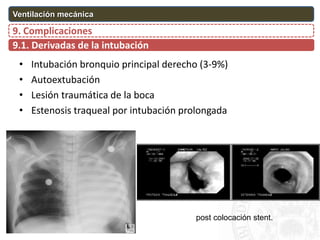 • Intubación bronquio principal derecho (3-9%)
• Autoextubación
• Lesión traumática de la boca
• Estenosis traqueal por intubación prolongada
9.1. Derivadas de la intubación
9. Complicaciones
Ventilación mecánica
post colocación stent.
 