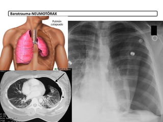 Barotrauma-NEUMOTÓRAX
 