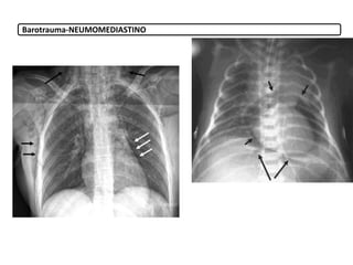 Barotrauma-NEUMOMEDIASTINO
 