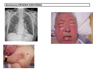 Barotrauma-ENFISEMA SUBCUTÁNEO
 