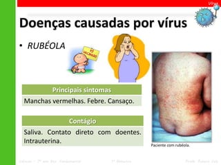 Vírus




Doenças causadas por vírus
• RUBÉOLA



                  Principais sintomas
  Manchas vermelhas. Febre. Cansaço.

                Contágio
  Saliva. Contato direto com doentes.
  Intrauterina.                                       Paciente com rubéola.


Ciências – 7º ano Ens. Fundamental      1º Bimestre                     Profa. Rebeca Vale
 