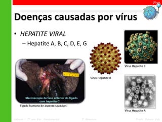 Vírus




Doenças causadas por vírus
• HEPATITE VIRAL
      – Hepatite A, B, C, D, E, G


                                                                  Vírus Hepatite C


                                               Vírus Hepatite B




    Fígado humano de aspecto saudável.
                                                                  Vírus Hepatite A

Ciências – 7º ano Ens. Fundamental       1º Bimestre                      Profa. Rebeca Vale
 