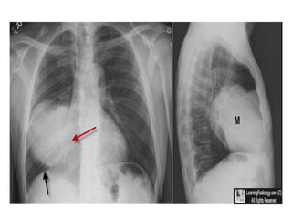 Comprehensive Overview of Chest Imaging Techniques and Diagnostic Signs ...