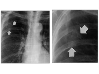 Comprehensive Overview of Chest Imaging Techniques and Diagnostic Signs ...