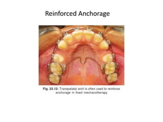 Reinforced Anchorage
 