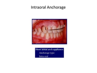 Intraoral Anchorage
 