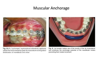 Muscular Anchorage
 