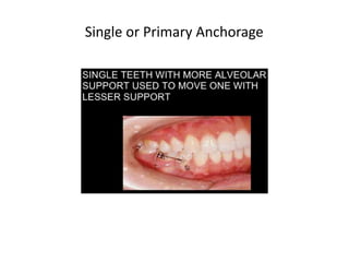 Single or Primary Anchorage
 