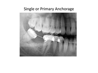 Single or Primary Anchorage
 
