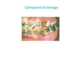 Compound Anchorage
 