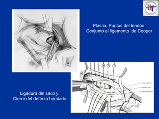 MC VAY
Ligadura del saco y
Cierre del defecto herniario
Plastia. Puntos del tendón
Conjunto al ligamento de Cooper
 