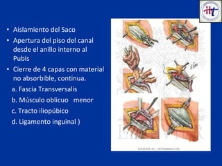 • Aislamiento del Saco
• Apertura del piso del canal
desde el anillo interno al
Pubis
• Cierre de 4 capas con material
no absorbible, continua.
a. Fascia Transversalis
b. Músculo oblicuo menor
c. Tracto iliopúbico
d. Ligamento inguinal )
 