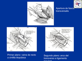 Apertura de fascia
transversalis
Primer plano: vaina de recto
a cintilla iliopúbica
Segundo plano: arco del
transverso a ligamento
 