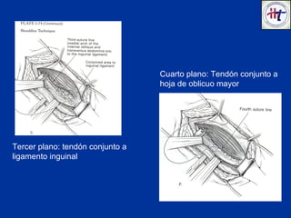 TÉCNICA DE
SHOULDICE
Tercer plano: tendón conjunto a
ligamento inguinal
Cuarto plano: Tendón conjunto a
hoja de oblicuo mayor
 