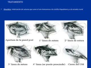 TRATAMIENTO
• Shouldice: imbricación de suturas que unen el om-transverso a la cintilla iliopubiana y a la arcada crural
 