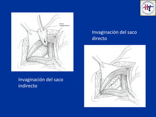 Invaginación del saco
indirecto
Invaginación del saco
directo
 