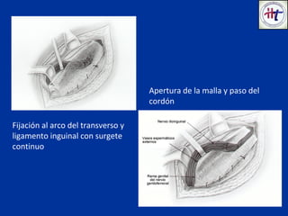 Fijación al arco del transverso y
ligamento inguinal con surgete
continuo
Apertura de la malla y paso del
cordón
 