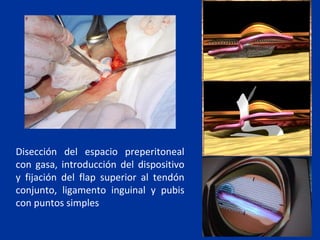 Disección del espacio preperitoneal
con gasa, introducción del dispositivo
y fijación del flap superior al tendón
conjunto, ligamento inguinal y pubis
con puntos simples
 