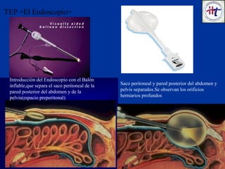 Introducción del Endoscopio con el Balón
inflable,que separa el saco peritoneal de la
pared posterior del abdomen y de la
pelvis(espacio preperitonal)
TEP =El Endoscopio=
Saco peritoneal y pared posterior del abdomen y
pelvis separados.Se observan los orificios
herniarios profundos
El Globo
 