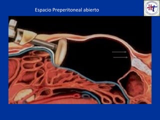 Espacio Preperitoneal abierto
 